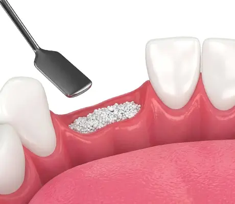 bone graft