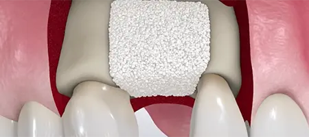 Post Operative Care for Bone Graft