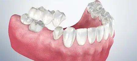 Post Operative Care for a Bridge