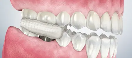 Post Operative Care for Healing Cap