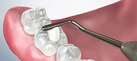 Post Operative Care for Composite Filling