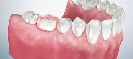 Post Operative Care for a Crown