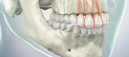 Post Operative Care for Permanent Veneers