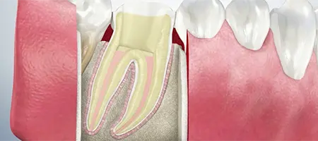Post Operative Care for Root Canal
