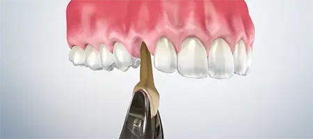 Post Operative Care for Simple Extractions