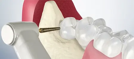 Post Operative Care for Surgical Extraction