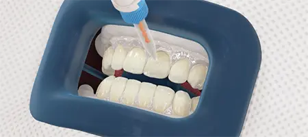 Post Operative Care for Teeth Whitening