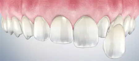 Post Operative Care for Temporary Veneers