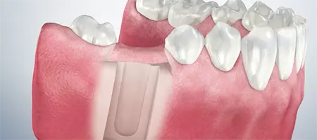 Post Operative Care for Temporary Crown